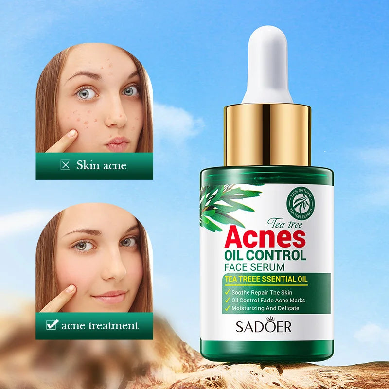 30ml Tea Tree Acne Removing Face Essence Oil Controlling Acne Printing Skin Care Product Moisturizing Facial Anti Acne Essence-Health Wisdom™