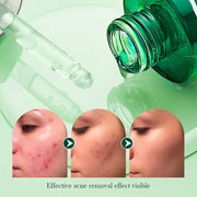 30ml Tea Tree Acne Removing Face Essence Oil Controlling Acne Printing Skin Care Product Moisturizing Facial Anti Acne Essence-Health Wisdom™