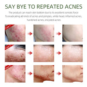 3pcs/Set Salicylic Acid Oil Control Acne Removing Skin Care Sets Serum Facial Anti Acne Removal Moisturizing Face Skin Care Kit-Health Wisdom™