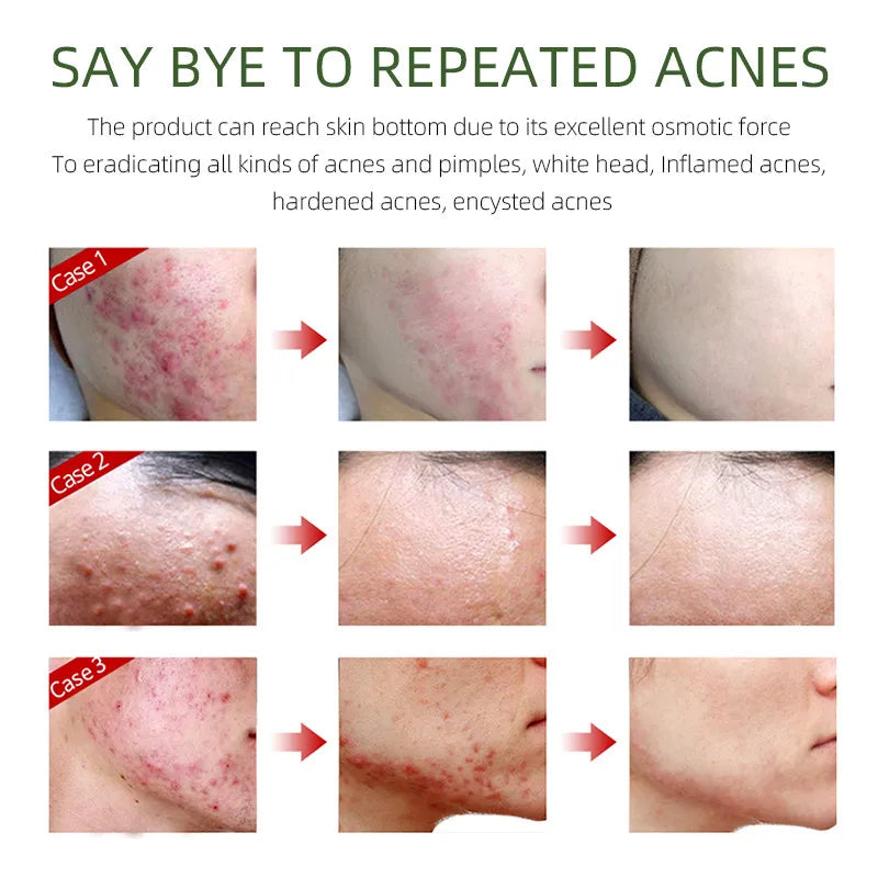 3pcs/Set Salicylic Acid Oil Control Acne Removing Skin Care Sets Serum Facial Anti Acne Removal Moisturizing Face Skin Care Kit-Health Wisdom™