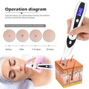 Laser Plasma Pen for Skin Tag Remover Freckle Dots Papilloma Warts Pimples Tattoo Mole Removal Pen 9 Speed LCD Beauty Care Tools-Health Wisdom™