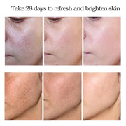 Whitening Freckle Cream Remove Melasma Cream Remove Dark Spots Melanin Melasma Remover Brighten Skin Anti-Aging Skin Lightening-Health Wisdom™