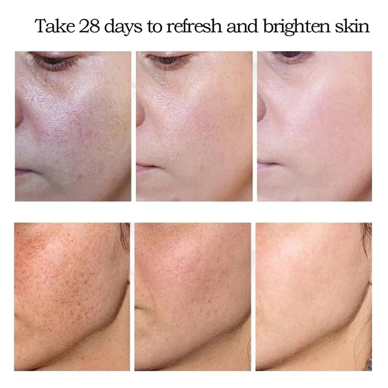 Whitening Freckle Cream Remove Melasma Cream Remove Dark Spots Melanin Melasma Remover Brighten Skin Anti-Aging Skin Lightening-Health Wisdom™